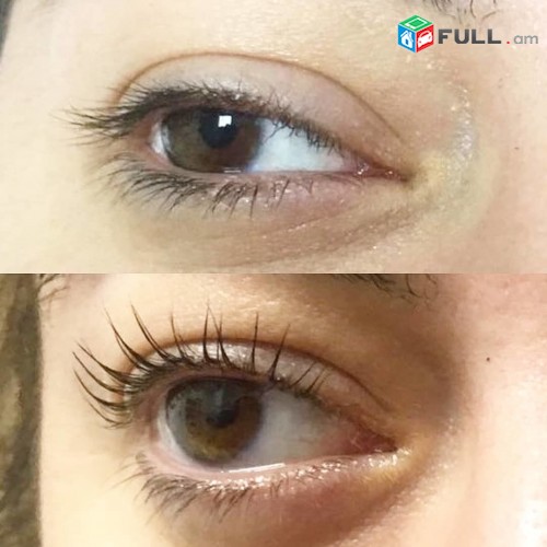 Tartichneri laminacia botox ev nerkum carayutyun  naev usucum